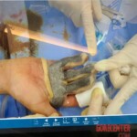 Painful hand injury caused by careless handling of angle grinder