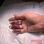 Painful hand injury caused by careless handling of angle grinder