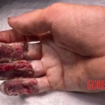 Painful hand injury caused by careless handling of angle grinder