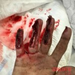 Painful hand injury caused by careless handling of angle grinder