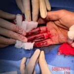 Painful hand injury caused by careless handling of angle grinder