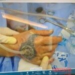 Painful hand injury caused by careless handling of angle grinder