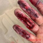 Painful hand injury caused by careless handling of angle grinder