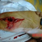 Suicidal jumper after impact from roof of skyscraper