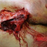 Suicidal jumper after impact from roof of skyscraper