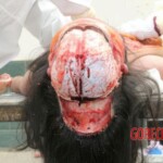 Examination and autopsy of Chinese woman