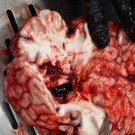 Examination and autopsy of murdered teenager