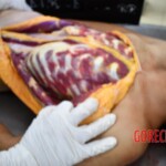 Examination and autopsy of murdered teenager
