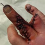 Man lost his fingers in work accident