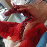 Man lost his fingers in work accident