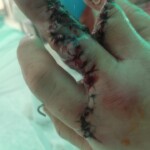 Man lost his fingers in work accident