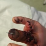 Man lost his fingers in work accident