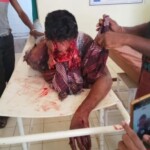 Face severely disfigured after bear attack
