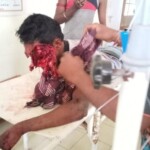 Face severely disfigured after bear attack