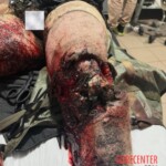 Heavily injured Ukrainian soldier receiving treatment in field hospital