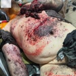 Heavily injured Ukrainian soldier receiving treatment in field hospital