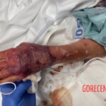 Necrotizing fasciitis