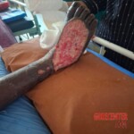 Necrotizing fasciitis