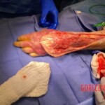 Necrotizing fasciitis