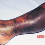 Necrotizing fasciitis