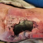 Necrotizing fasciitis