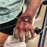 Necrotizing fasciitis