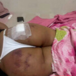 Brazilian butt lift gone wrong