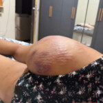 Brazilian butt lift gone wrong