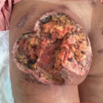 Brazilian butt lift gone wrong