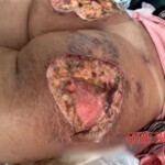 Brazilian butt lift gone wrong