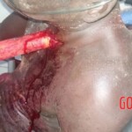 Bricklayer impaled by hammer in freak accident