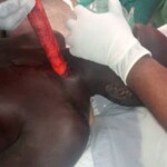 Bricklayer impaled by hammer in freak accident