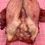 Complete hysterectomy + bilateral oophorectomy