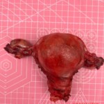 Complete hysterectomy + bilateral oophorectomy