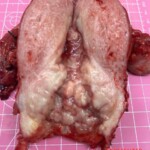 Complete hysterectomy + bilateral oophorectomy