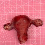 Complete hysterectomy + bilateral oophorectomy
