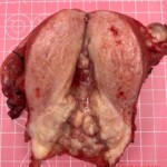 Complete hysterectomy + bilateral oophorectomy