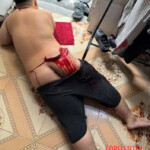 Deep cut caused by improper toilet use