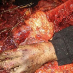 Farmer completely crushed by agricultural machinery