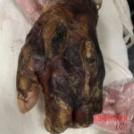 Fish bite turns into deadly infection