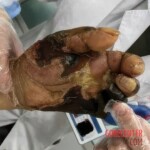 Fish bite turns into deadly infection