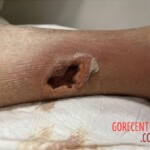 Fish bite turns into deadly infection