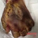 Fish bite turns into deadly infection