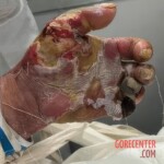 Fish bite turns into deadly infection