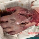 Fish bite turns into deadly infection