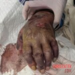 Fish bite turns into deadly infection