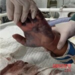 Fish bite turns into deadly infection