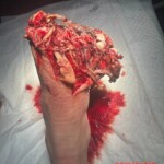 Landmine explosion destroyed Ukrainian soldier's foot