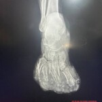 Landmine explosion destroyed Ukrainian soldier's foot