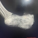 Landmine explosion destroyed Ukrainian soldier's foot